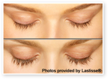 Restylane