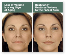 Restylane